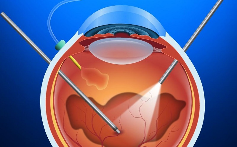 Cắt dịch kính là phương pháp phẫu thuật được áp dụng phổ biến trong điều trị xuất huyết dịch kính